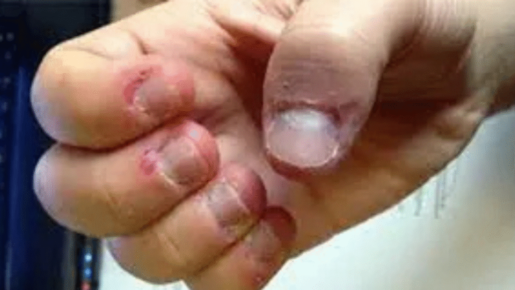 Person struggling with compulsive skin picking, holding their hand with visible stress, symbolizing Skin Picking OCD.