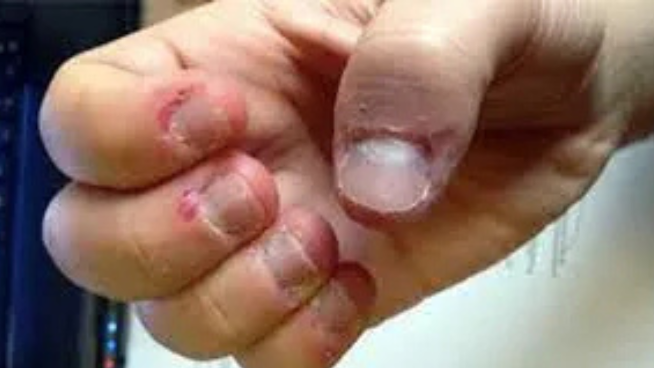Person struggling with compulsive skin picking, holding their hand with visible stress, symbolizing Skin Picking OCD.