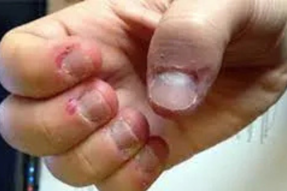 Person struggling with compulsive skin picking, holding their hand with visible stress, symbolizing Skin Picking OCD.